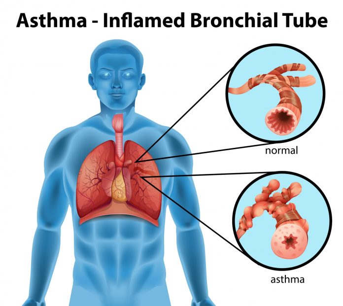 Role of Homoeopathy in Asthma